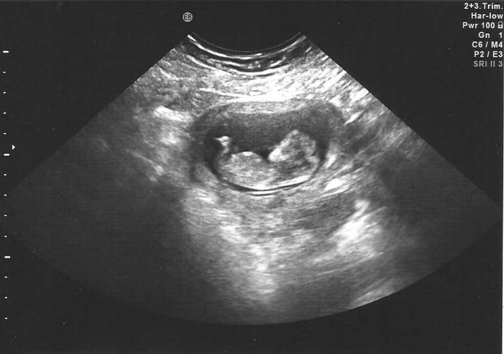 УЗИ на 10 акушерской неделе беременности. Фото плода на 10 неделе беременности по УЗИ. 10 Недель беременности фото ребенка на УЗИ плода. Сколько будет 11 недель