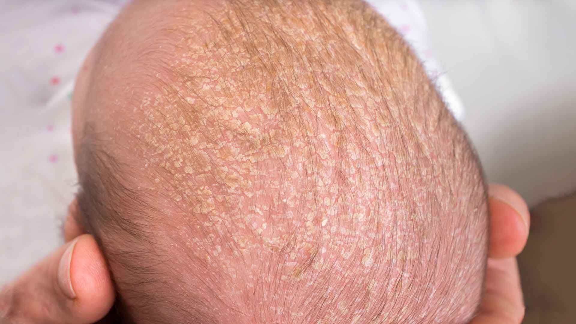 Лечение болячек и ранок на коже головы — причины появления корок в волосах - клиника «доктор волос»
