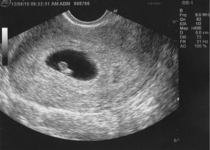 6 неделя беременности: ощущения, признаки, развитие плода