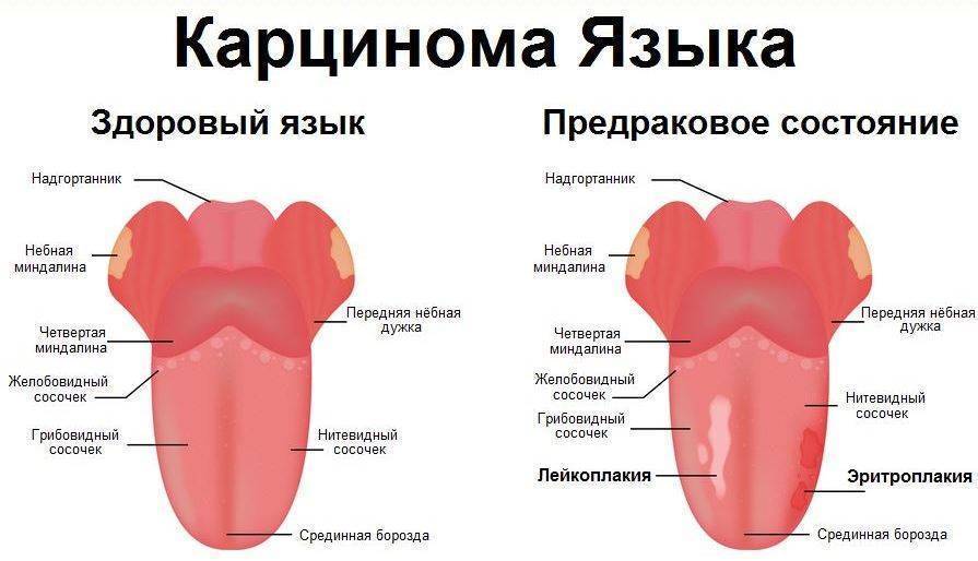 Причины появления белого налета на языке у грудничка, профилактика и лечение