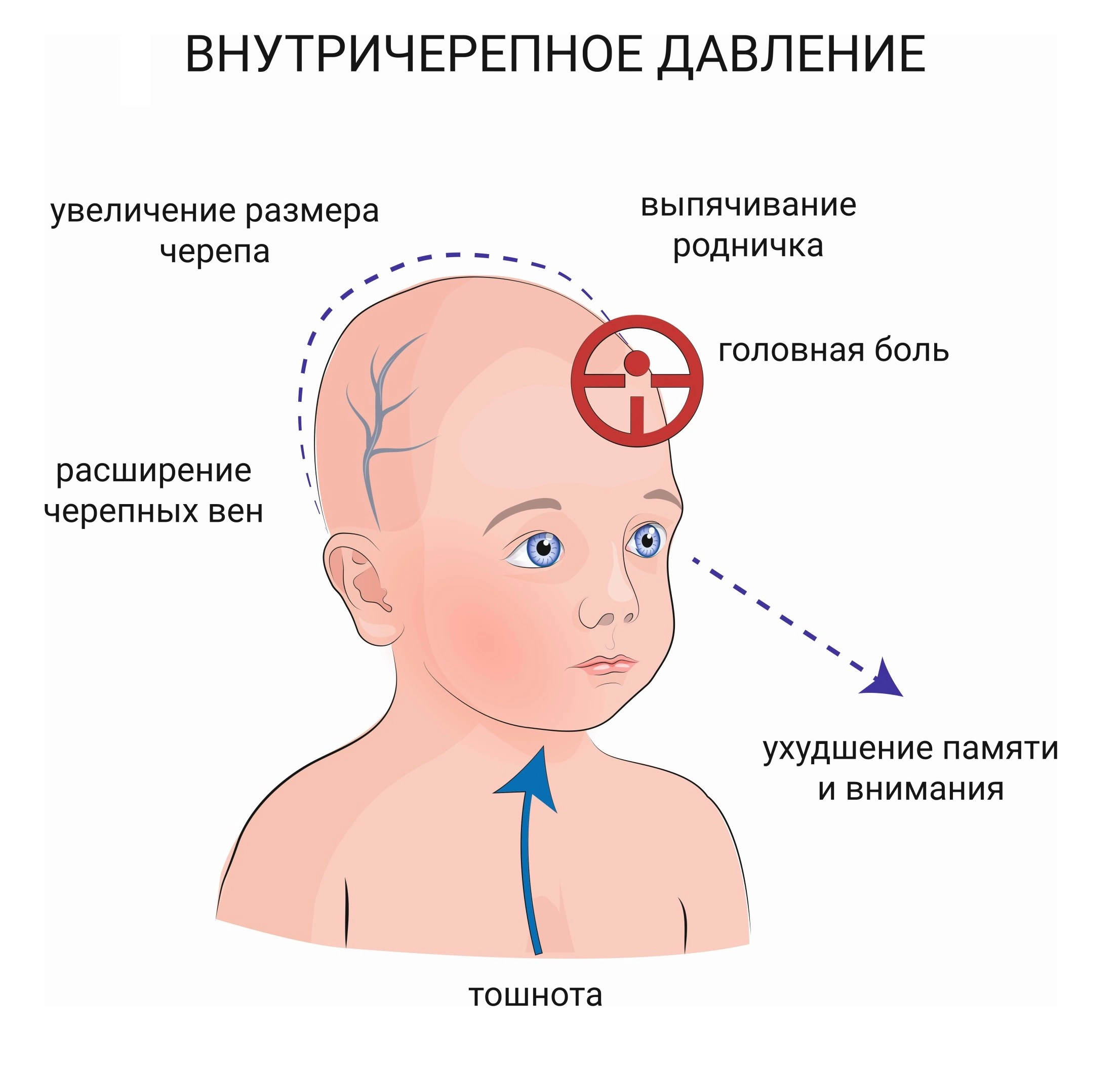 Гипотония у новорожденного. Внутричерепное давление у ребенка в год симптомы. Внутричерепное давление у ребенка грудничка симптомы. Внутричерепное давление симптомы у детей 9. Симптомы ВЧД У грудничка 6 месяцев.