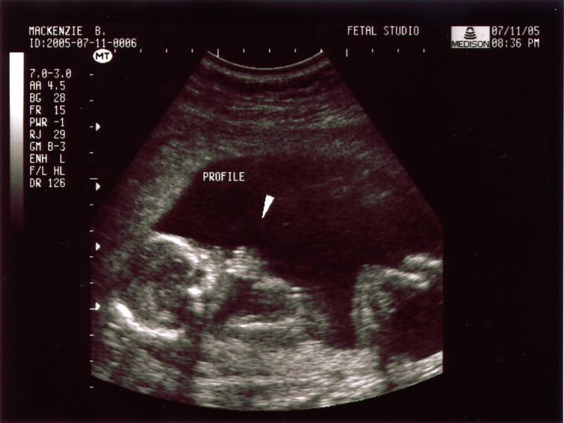 15 неделя 2023. УЗИ плода на 15 неделе беременности. 15-16 Недель беременности.