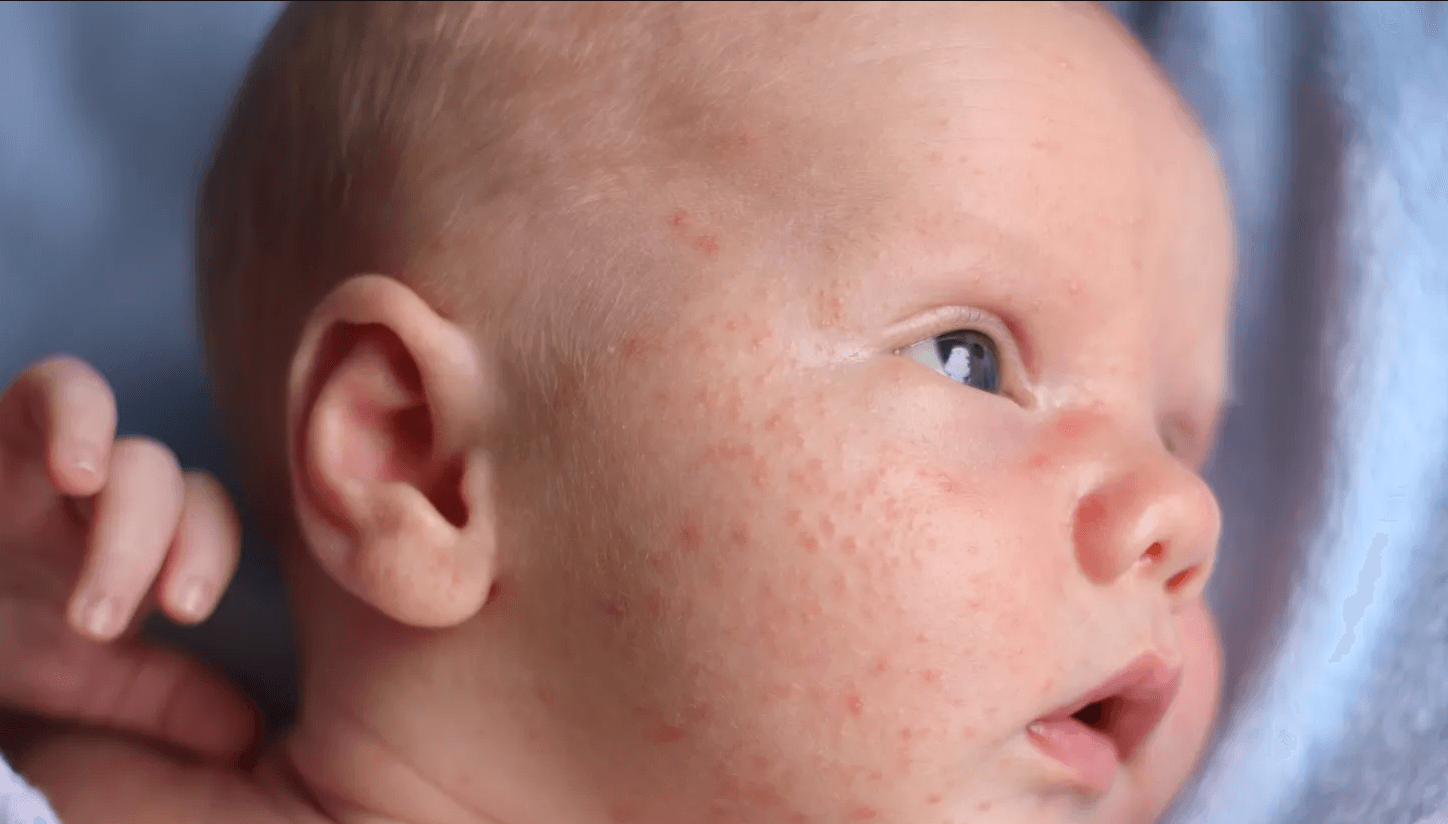 Акне новорожденных на лице: особенности и лечение, как выглядет | prof-medstail.ru