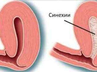 Внутриматочные синехии (сращения)