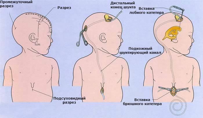 Повышенное внутричерепное давление у ребенка