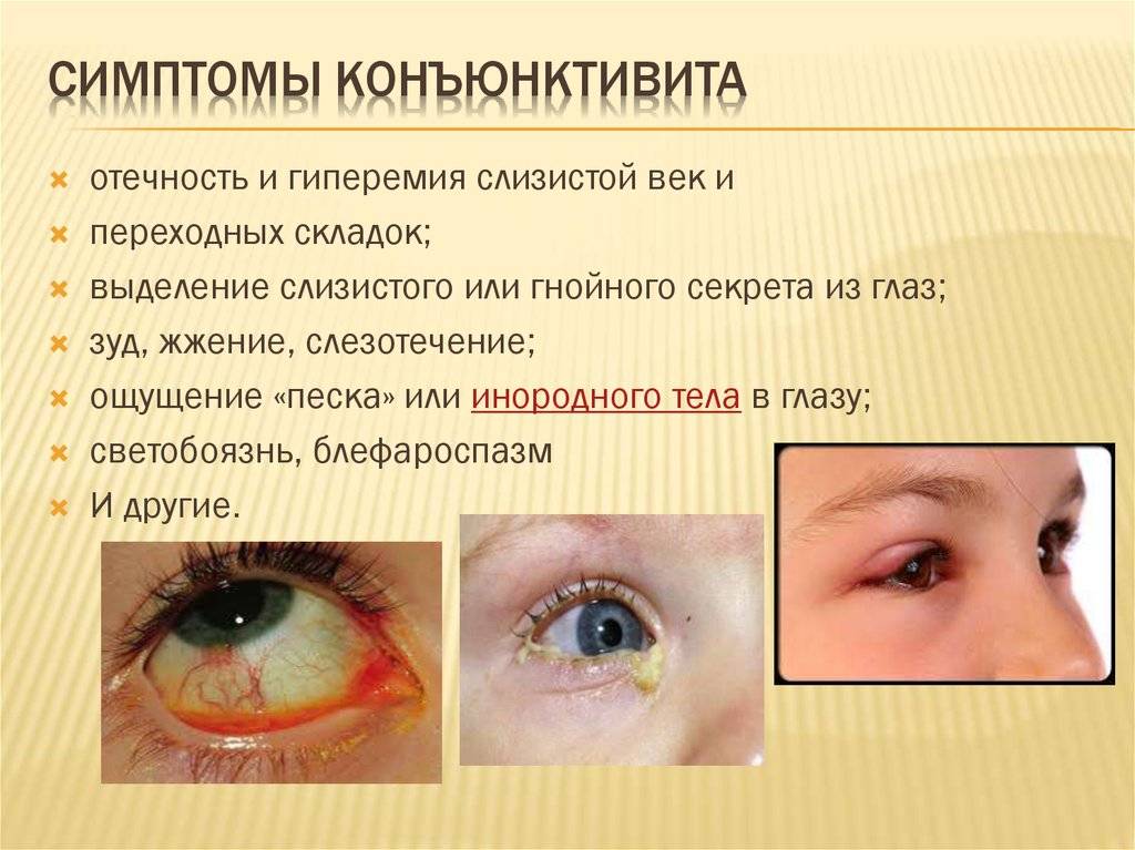 Закисание глаз, гнойные выделения у детей: симптомы, профилактика
