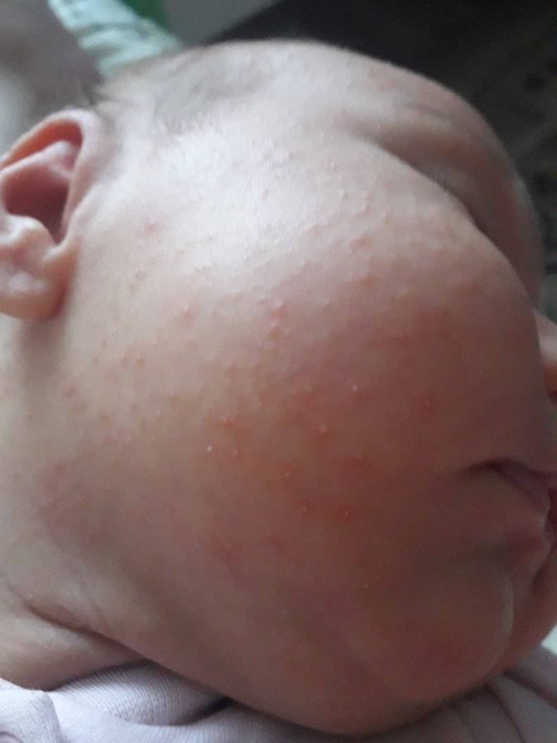 Потница у новорожденных: фото симптомов, причины появления, особенности лечения, мнение комаровского