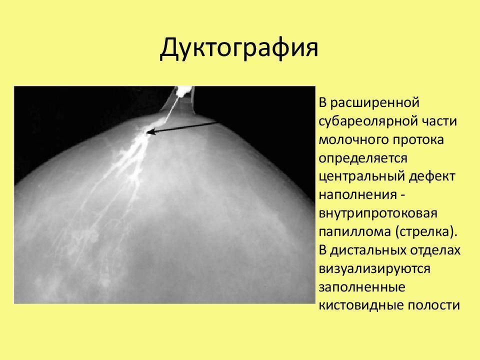 Белые точки на сосках у женщин: причины и лечение. консультация маммолога :: syl.ru