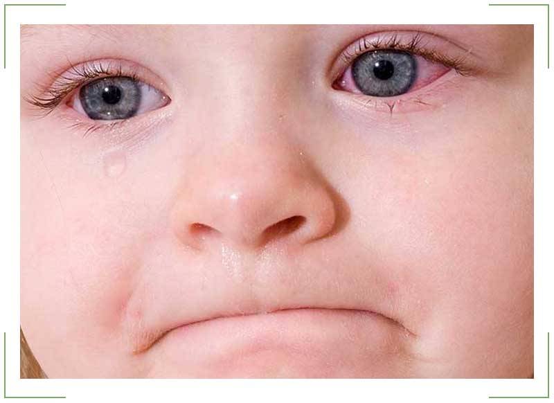 Что делать, если опух глаз у ребенка
