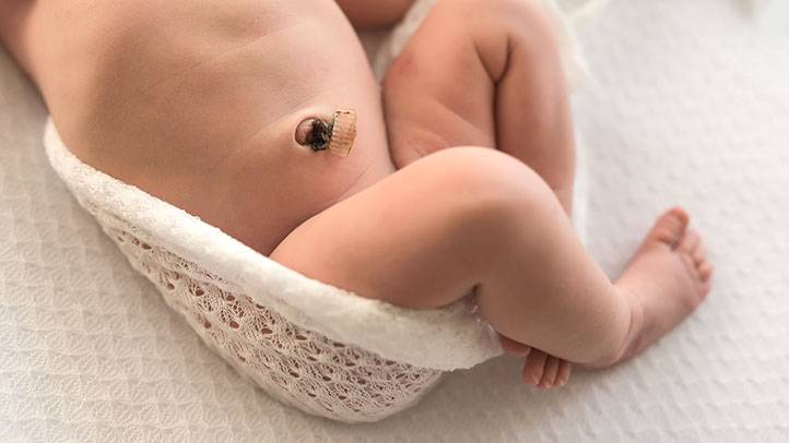 Кровит пупок у новорожденного с прищепкой или после ее отпадения