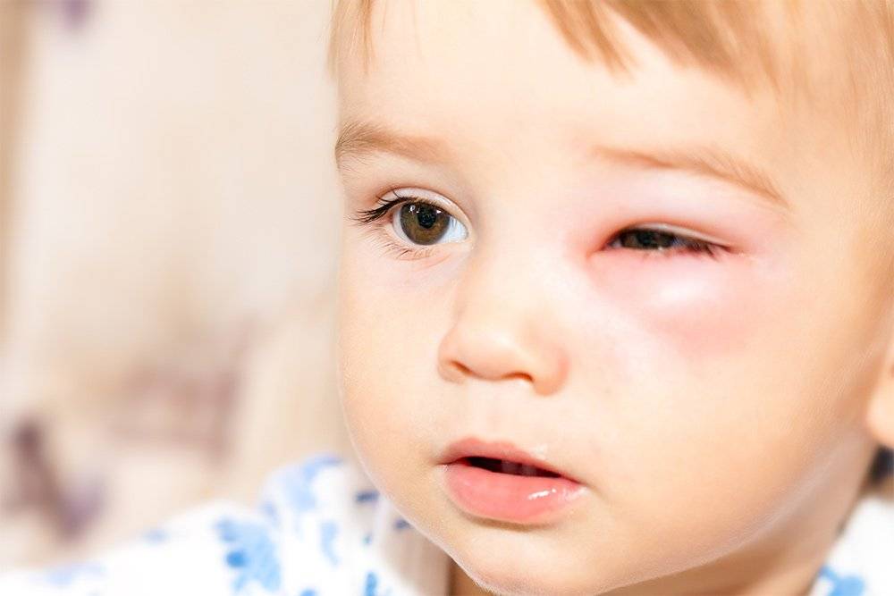 У ребенка отеки под глазами – причины и лечение 2024