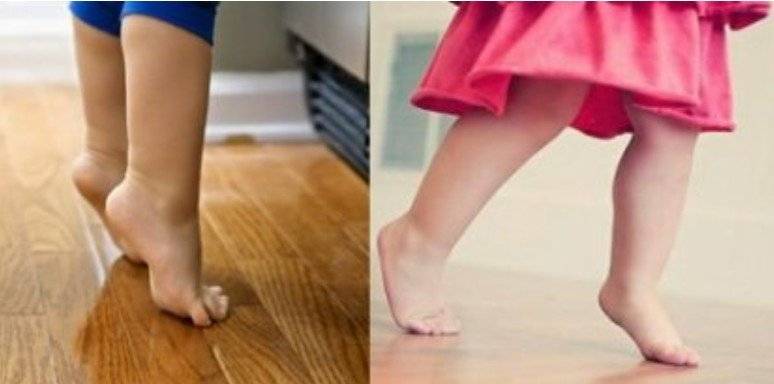 Ходьба на носочках у детей. Ребенок ходит на цыпочках. Почему ребенок ходит на цыпочках. Ходьба на носочках у детей. Ходьба на носочках.