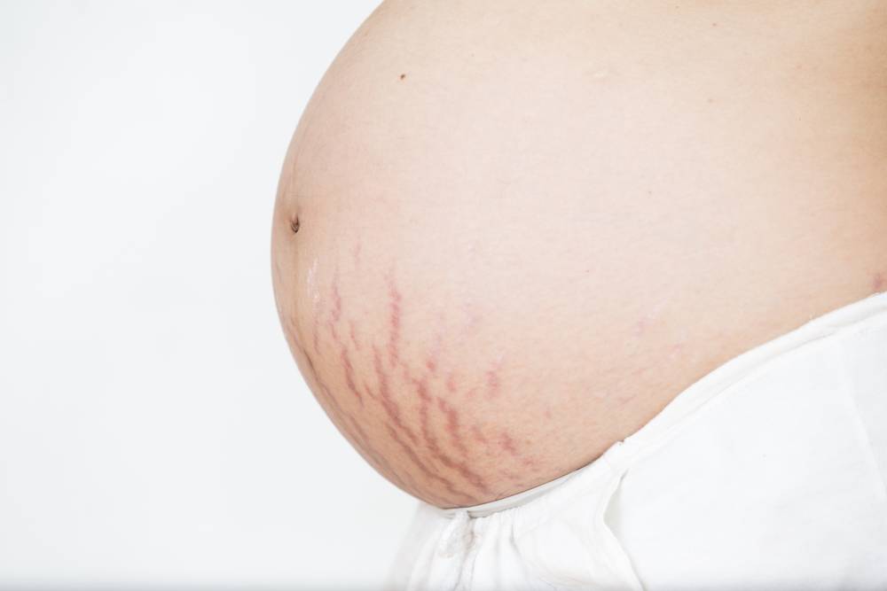 Как избежать растяжек при беременности: профилактика растяжек | mustela