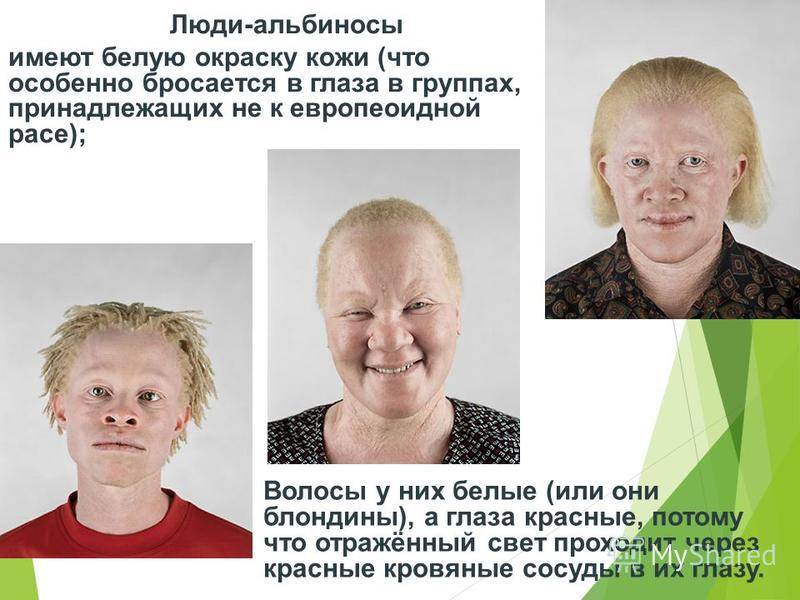 Люди альбиносы - интересные факты и фото