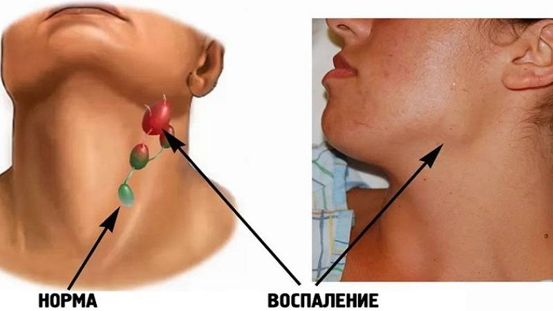 Лимфаденит у детей: 17 форм болезни, врачебные рекомендации по профилактике и о принципах лечения