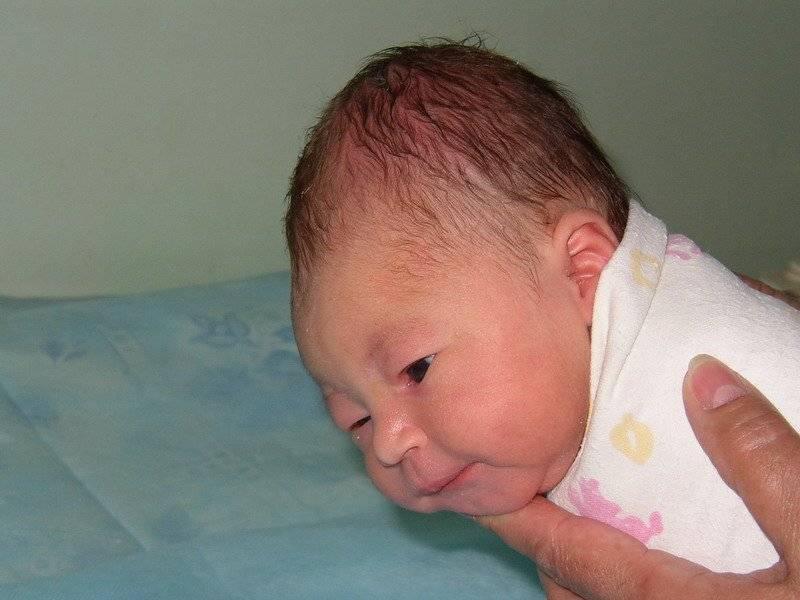 Кефалогематома - гематома у новорожденных на голове: последствия, лечение | азбука здоровья