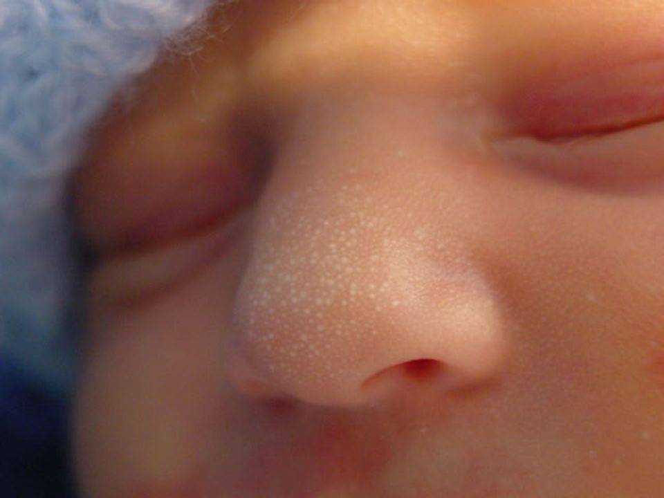 Белые точки на носу у новорожденных – заболевание или норма?