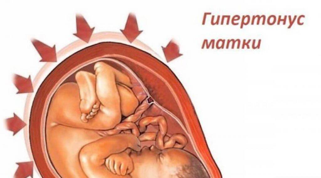 Тонус матки при беременности | уроки для мам