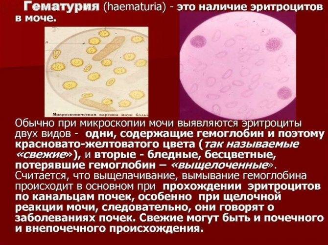 Цистит у детей