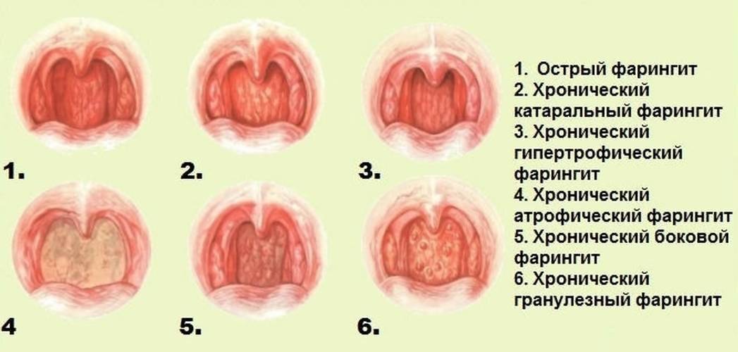 Чем лечить горло маме при грудном вскармливании