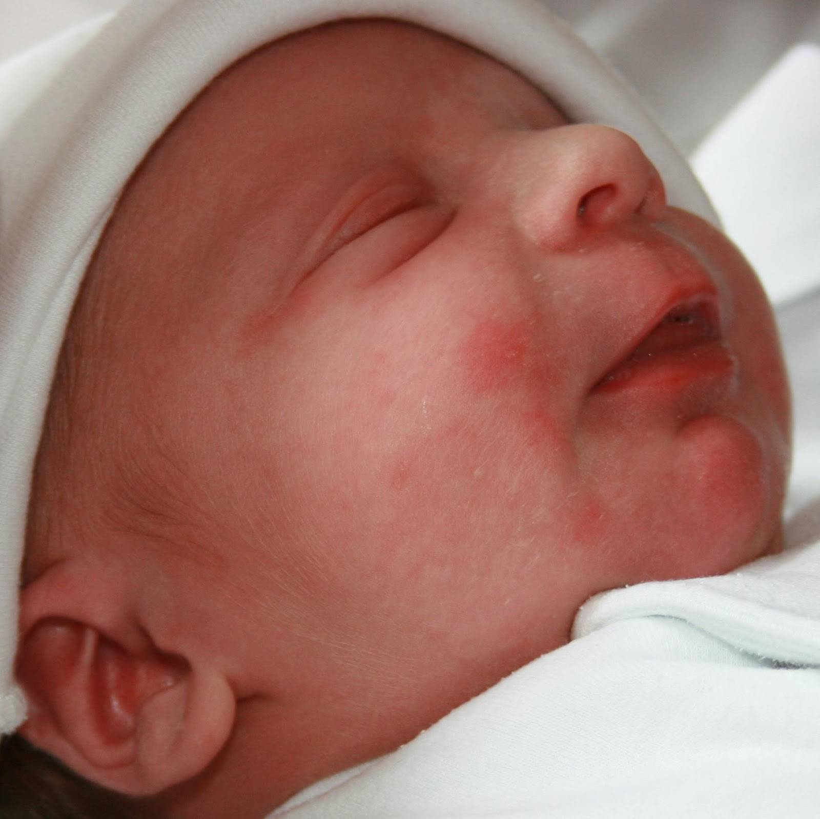 Потница у новорожденных: фото потнички у ребенка, симптомы и лечение