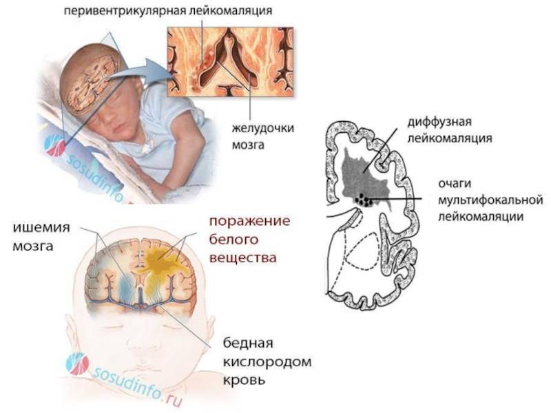 Внутриутробное поражение головного мозга. Ишемия головного мозга у новорожденного. Дети с кровоизлиянием в мозг родовая травма. Перивентрикулярная ишемия у новорожденного.