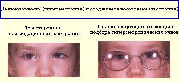 Косоглазие у детей: причины и лечение