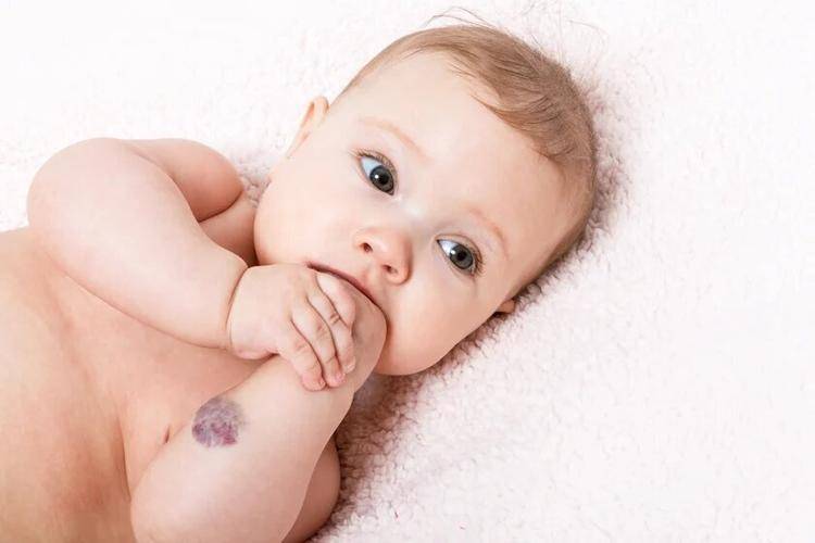 Гемангиомы у новорожденных: причины возникновения, лечение, последствия