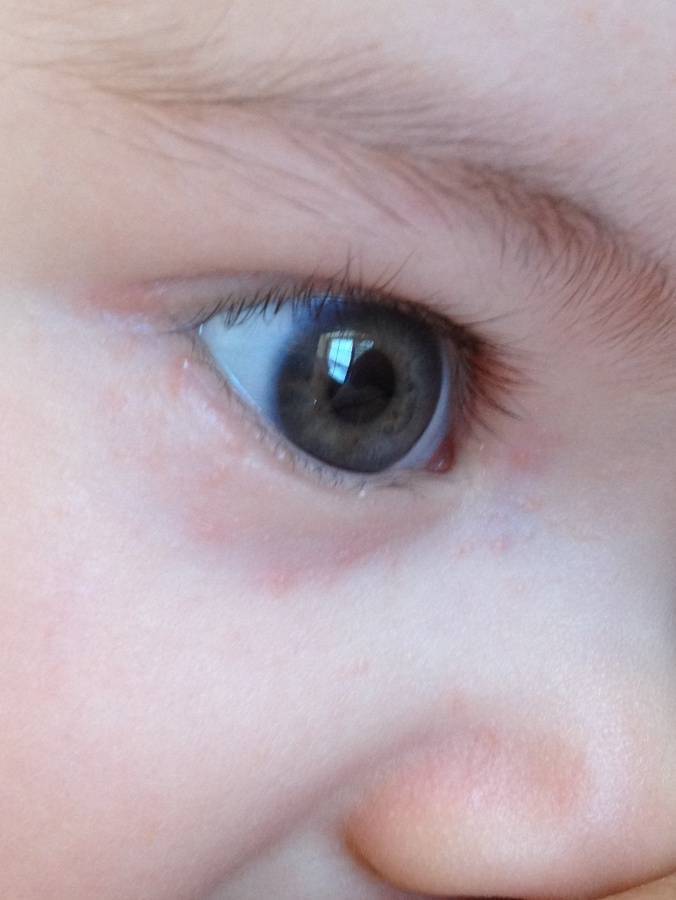 Белки глаз новорожденного. Прыщики под глазами у ребенка. Высыпания под глазом у ребенка.