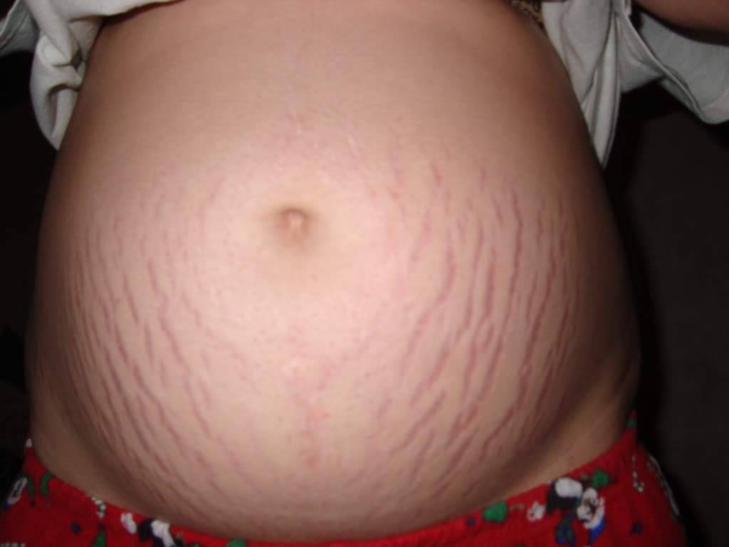 Во время беременности появились волосы на животе: почему это произошло?