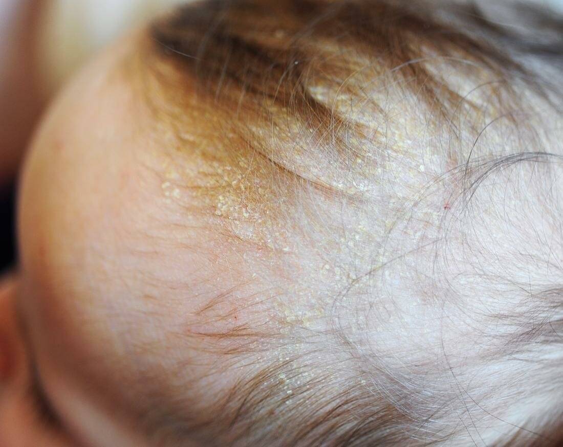 У грудничка на голове корочки - как убрать себорейные, желтые, белые корочки с головы младенца