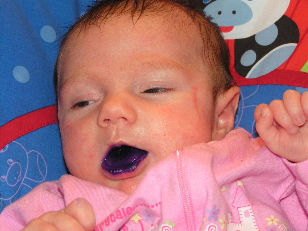 Кандидоз полости рта у детей: симптомы, причины, лечение