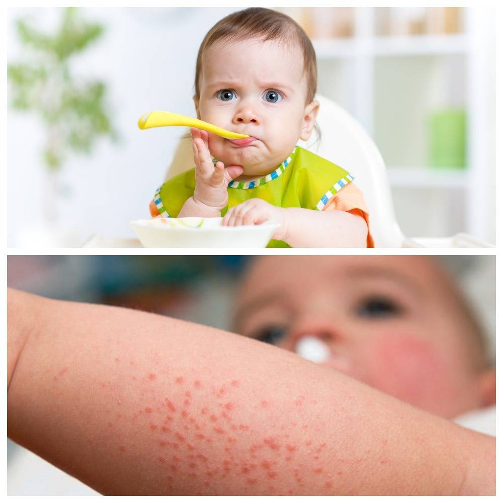 Аллергические реакции у детей - диагностика и лечение в спб | детский аллерголог см-клиника
