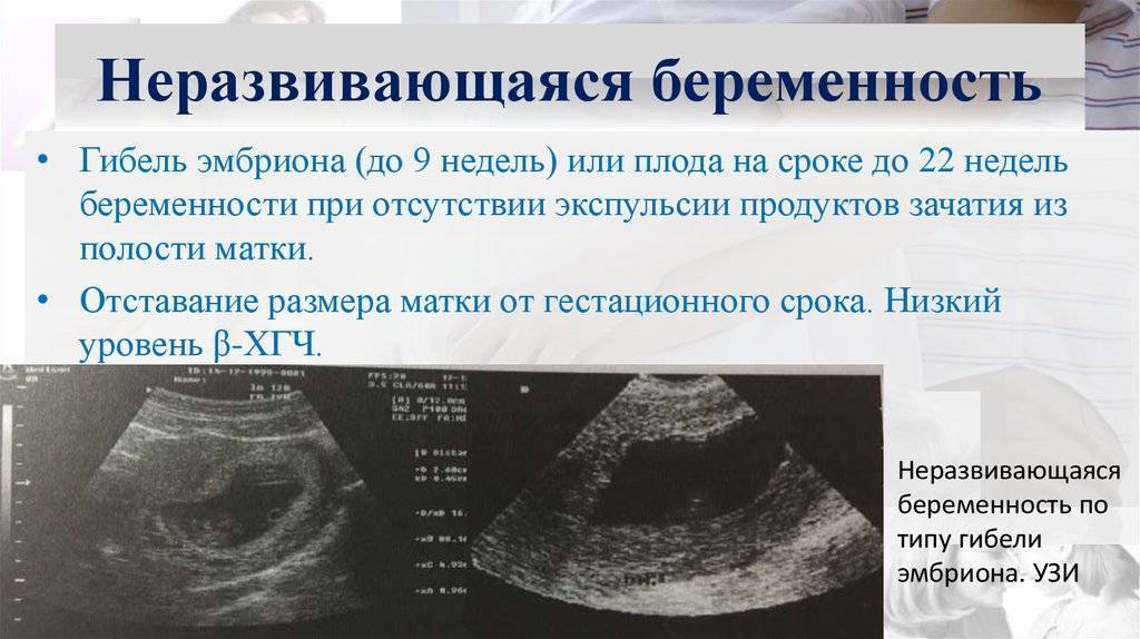 Замершая беременность: признаки, причины на ранних сроках