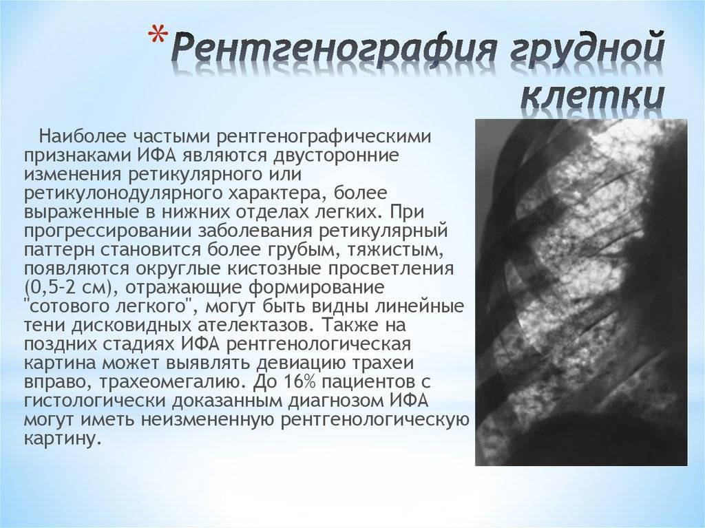 Можно ли делать флюорографию кормящей маме при гв (грудном вскармливании), как правильно проходить диагностику