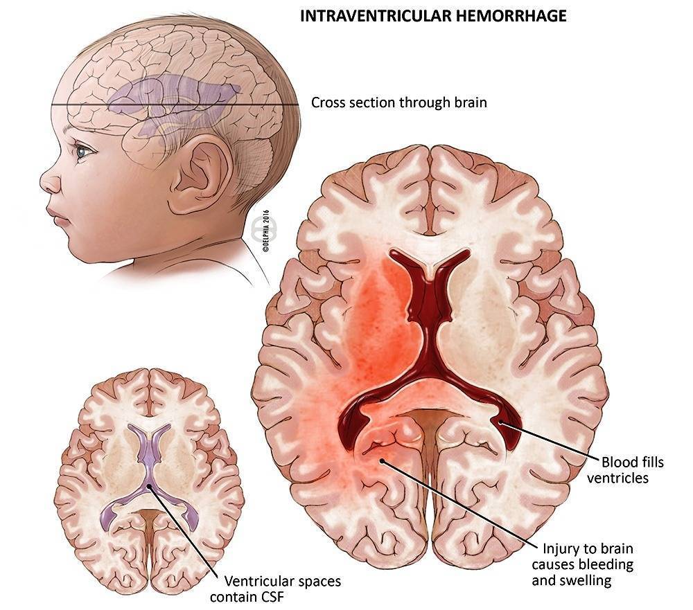 Субэпендимальная киста мозга у новорожденных детей: причины, опасна или нет?
