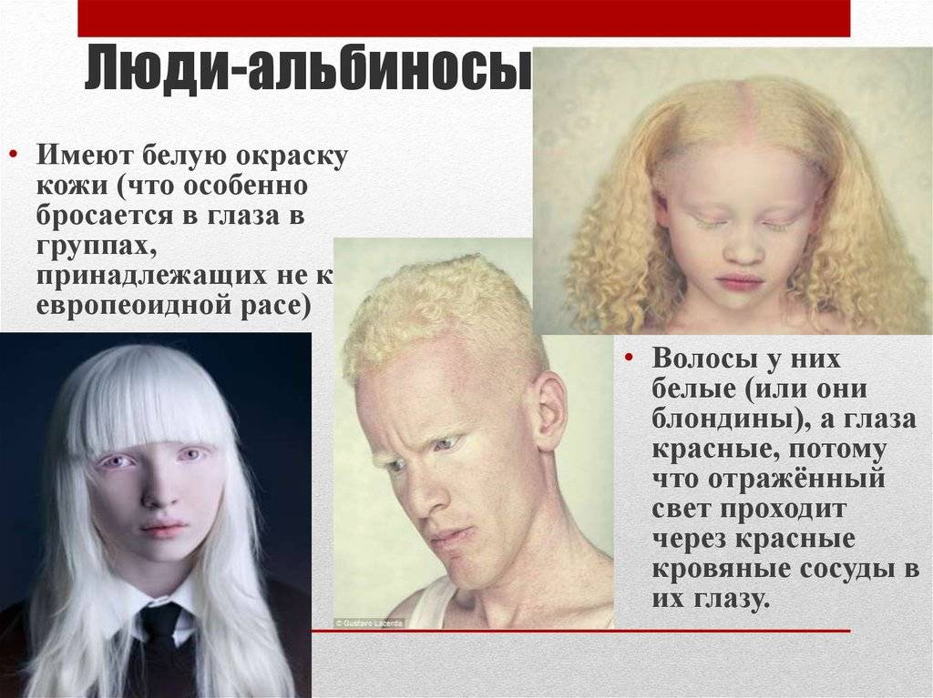 Кто такие люди-альбиносы? почему люди рождаются альбиносами?