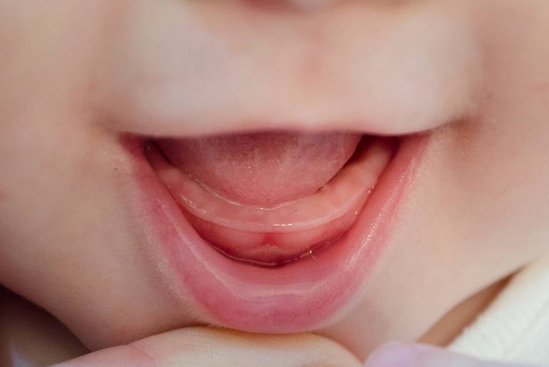 Признаки прорезывания зубов у младенца - типичные симптомы и что с ними делать