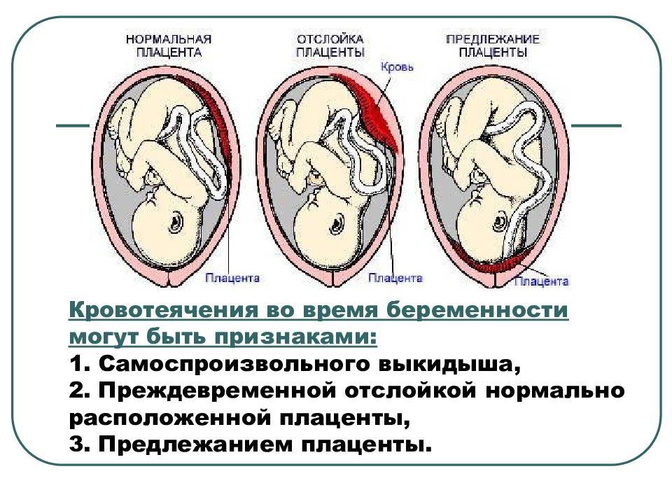 Отслойка плаценты на ранних и поздних сроках, отслойка нормально распложенной плаценты: симптомы, диагностика, лечение / mama66.ru