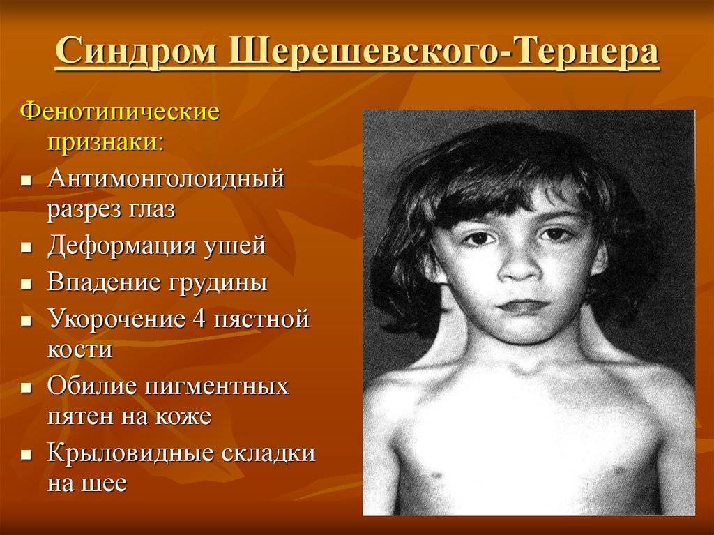 Синдром шерешевского -тёрнера: 3 вариации геномных нарушений, обзор симптомов в раннем и старшем периодах детства - первый портал по медицине