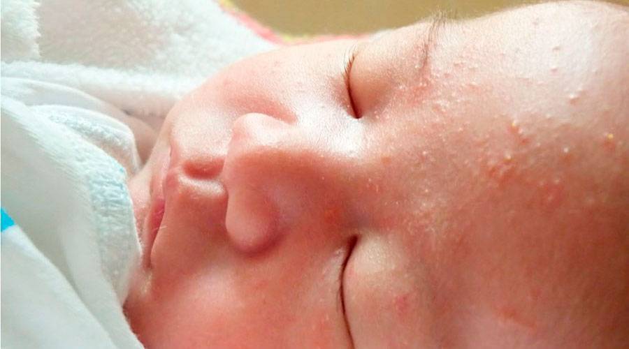 Потница у новорожденных: причины, симптомы, лечение