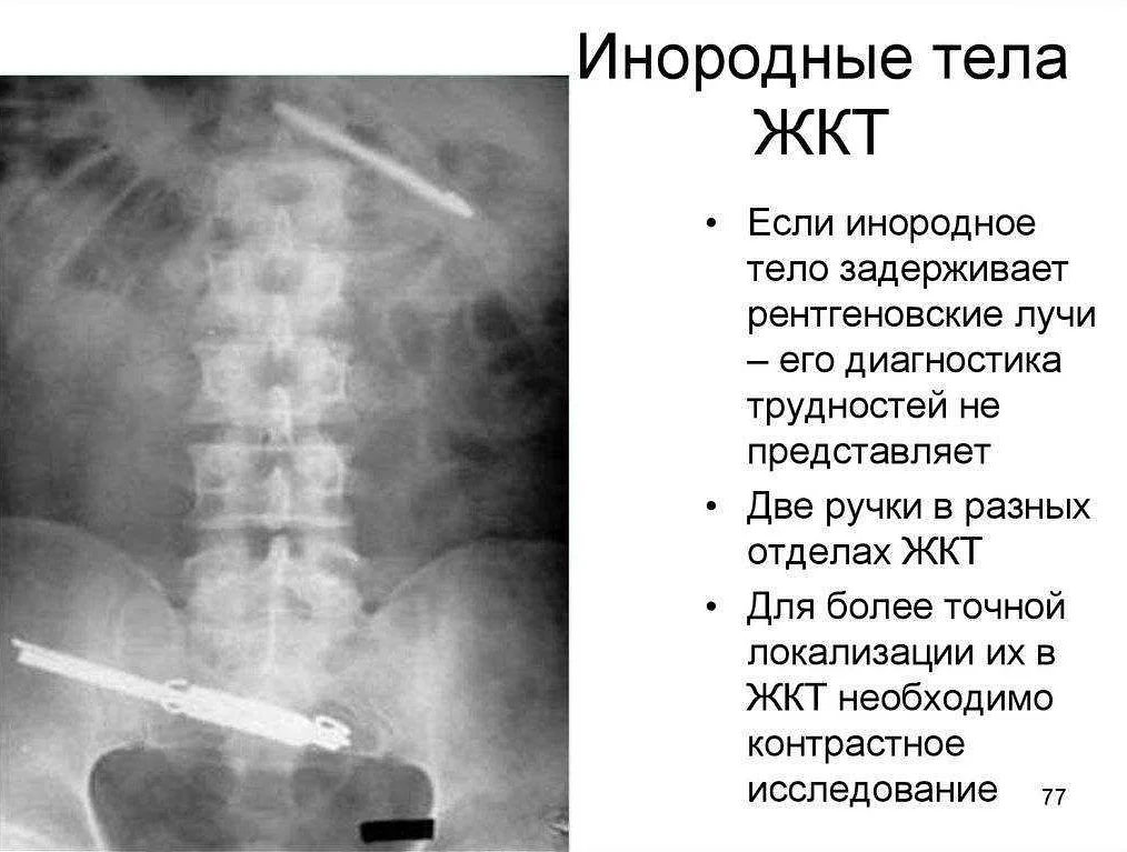 Что делать, если ребёнок проглотил инородное тело