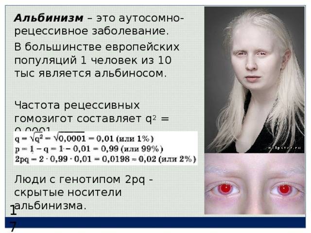Альбинизм: фото, причины и лечение, диагностика