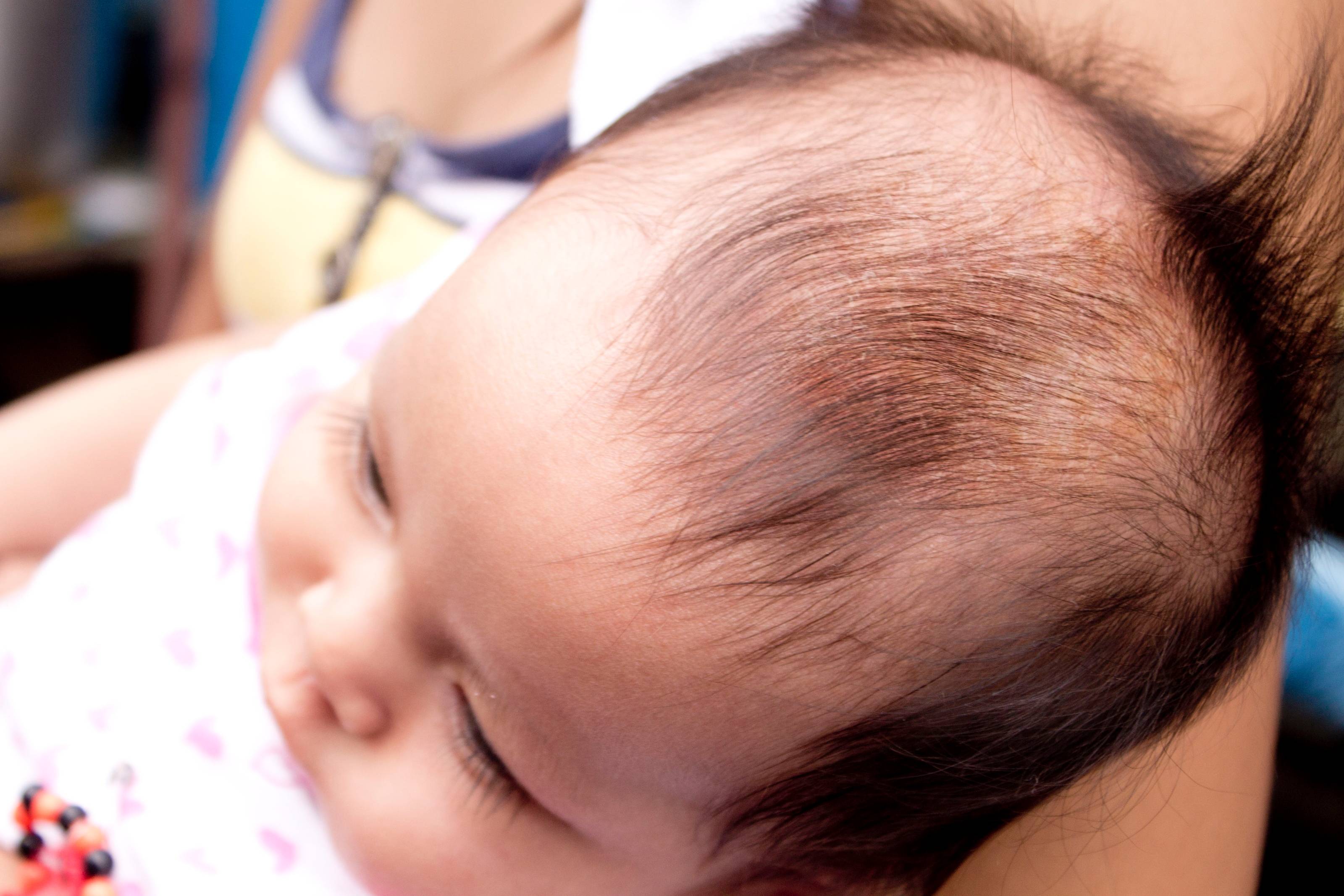 Себорейный дерматит у грудничка: как убрать корочки на голове у ребенка