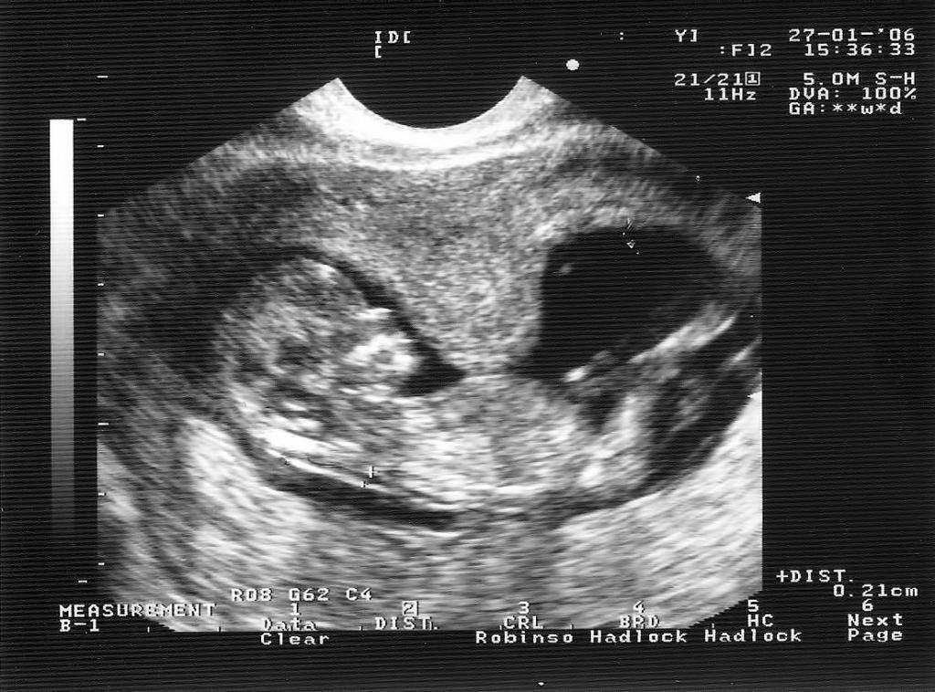 Тонус матки при беременности: симптомы на ранних сроках, причины, лечение - women first