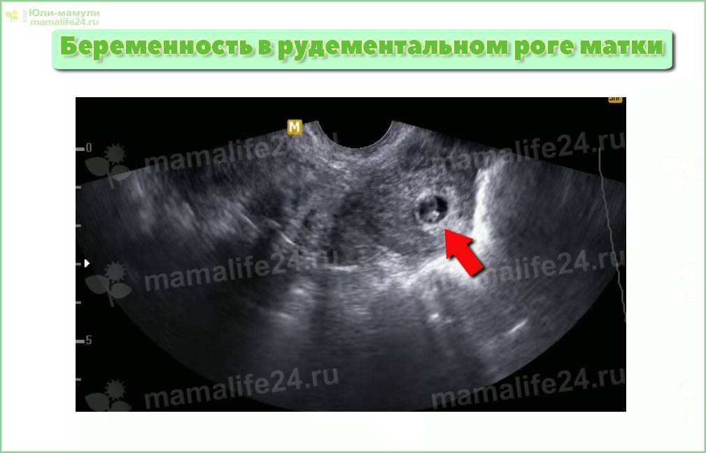 Беременность после перевязки маточных труб - вероятность, риски