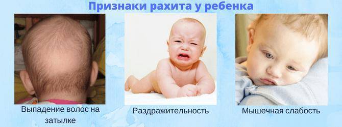Рахит у детей: симптомы, лечение и профилактика рахита у детей