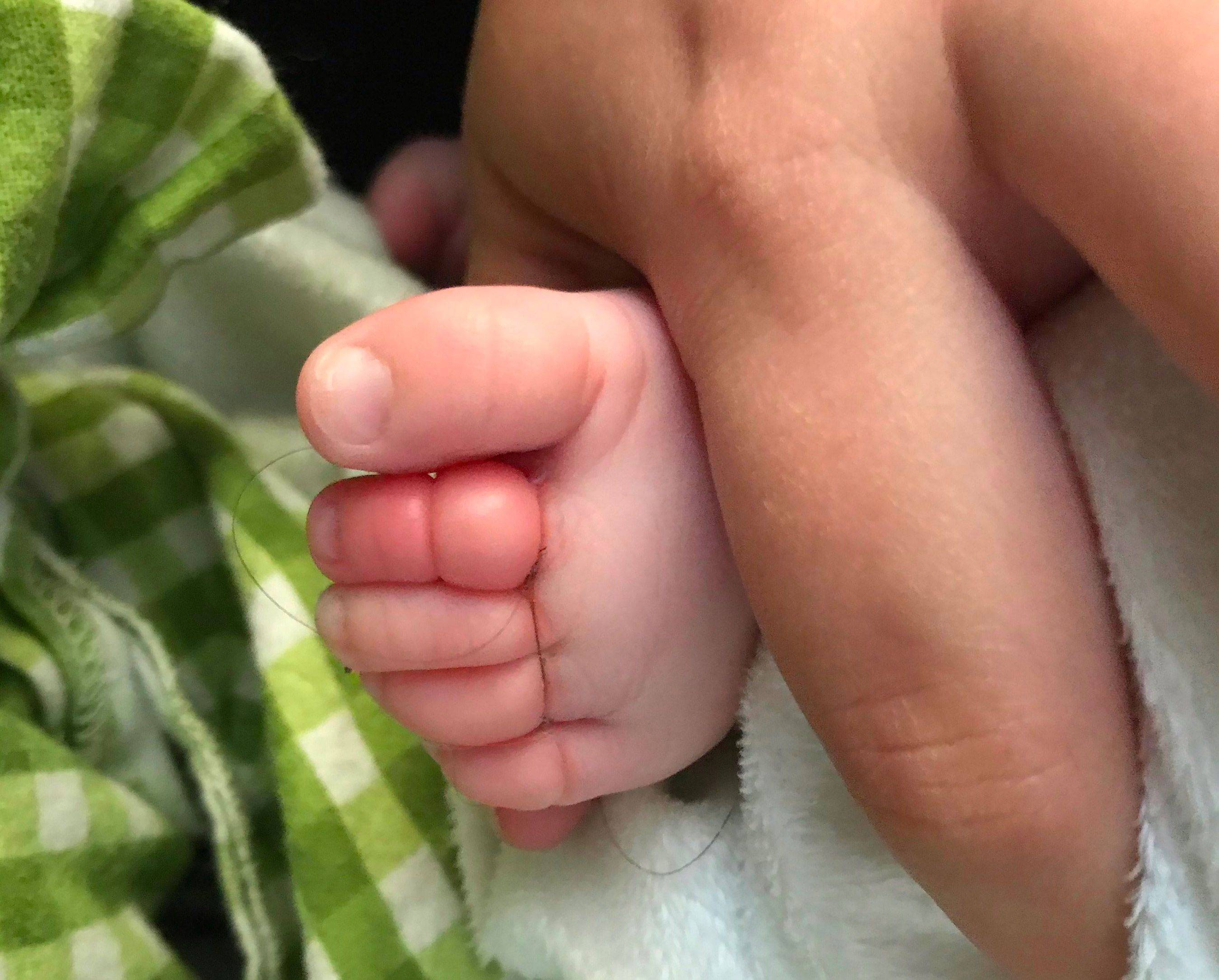 Красная попа у новорожденного: причины раздражения, чем помочь малышу