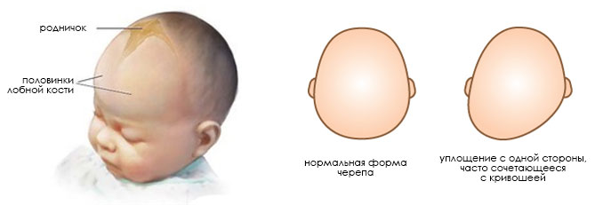 Затылок норма. Форма головы сбоку младенца. Форма головы у грудничка 4 месяца норма. Форма головы у 2 месячного ребенка норма.