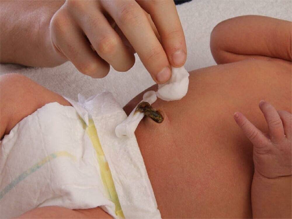 Пупочная грыжа у детей - лечение, симптомы, профилактика | детская хирургия см-клиники в санкт-петербурге